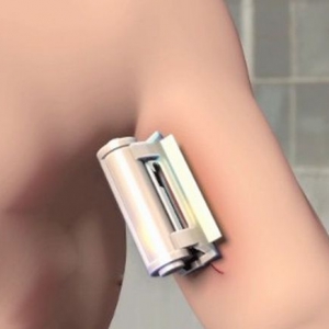 自助式伤口缝合器