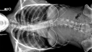 首台磁性控制骨骼矫正器