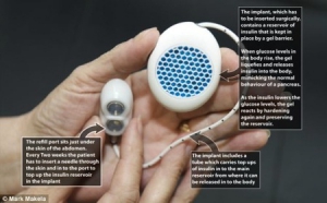 胰岛素自动释放仪